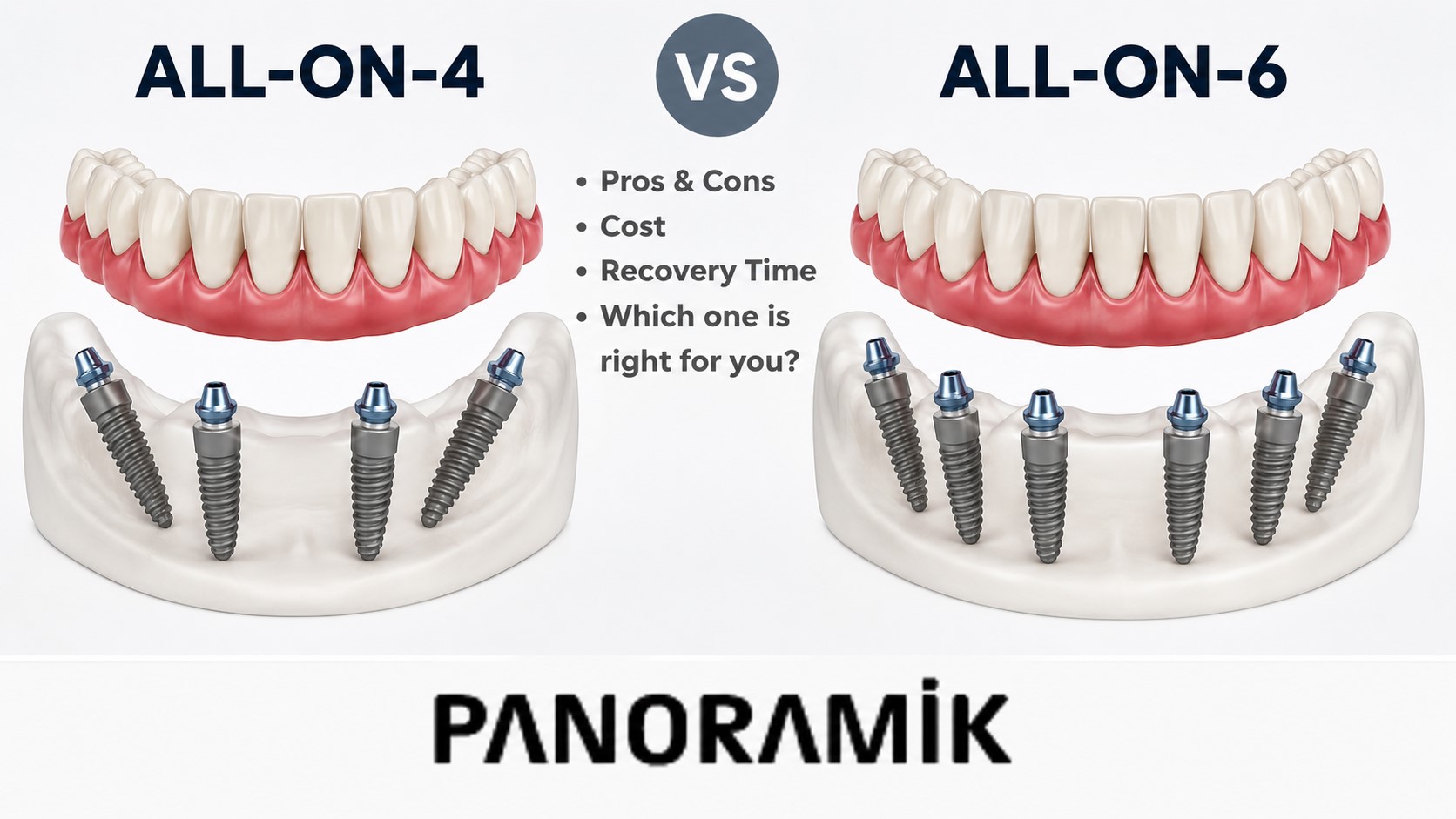 All-on-4 vs All-on-6 Dental Comparison