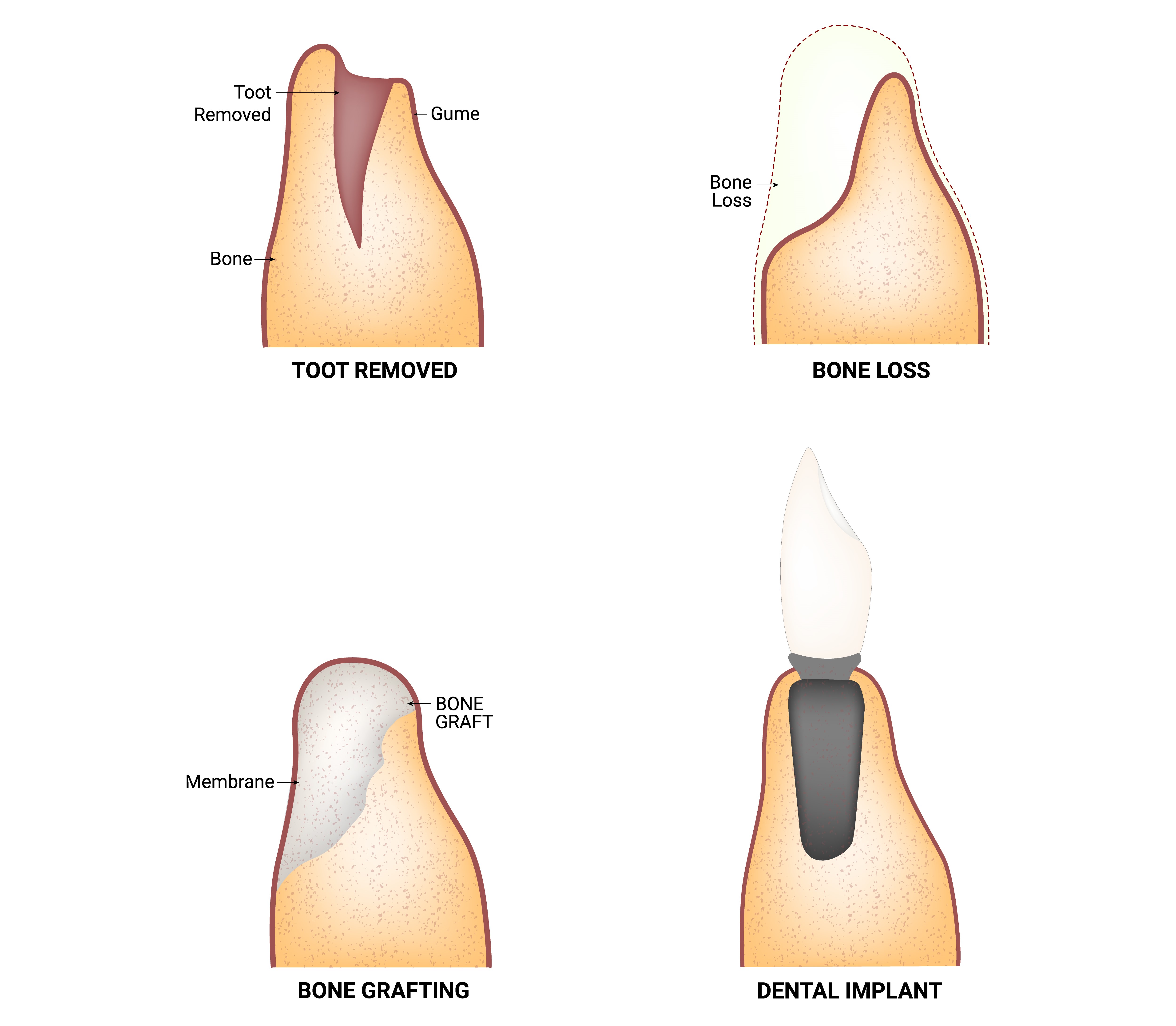 How is a bone grafting procedure performed?