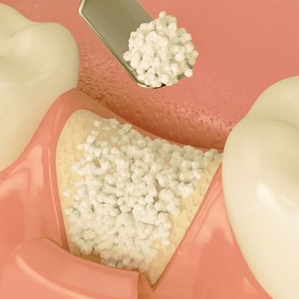 dental-bone-graft-turkey-turkey-antalya
