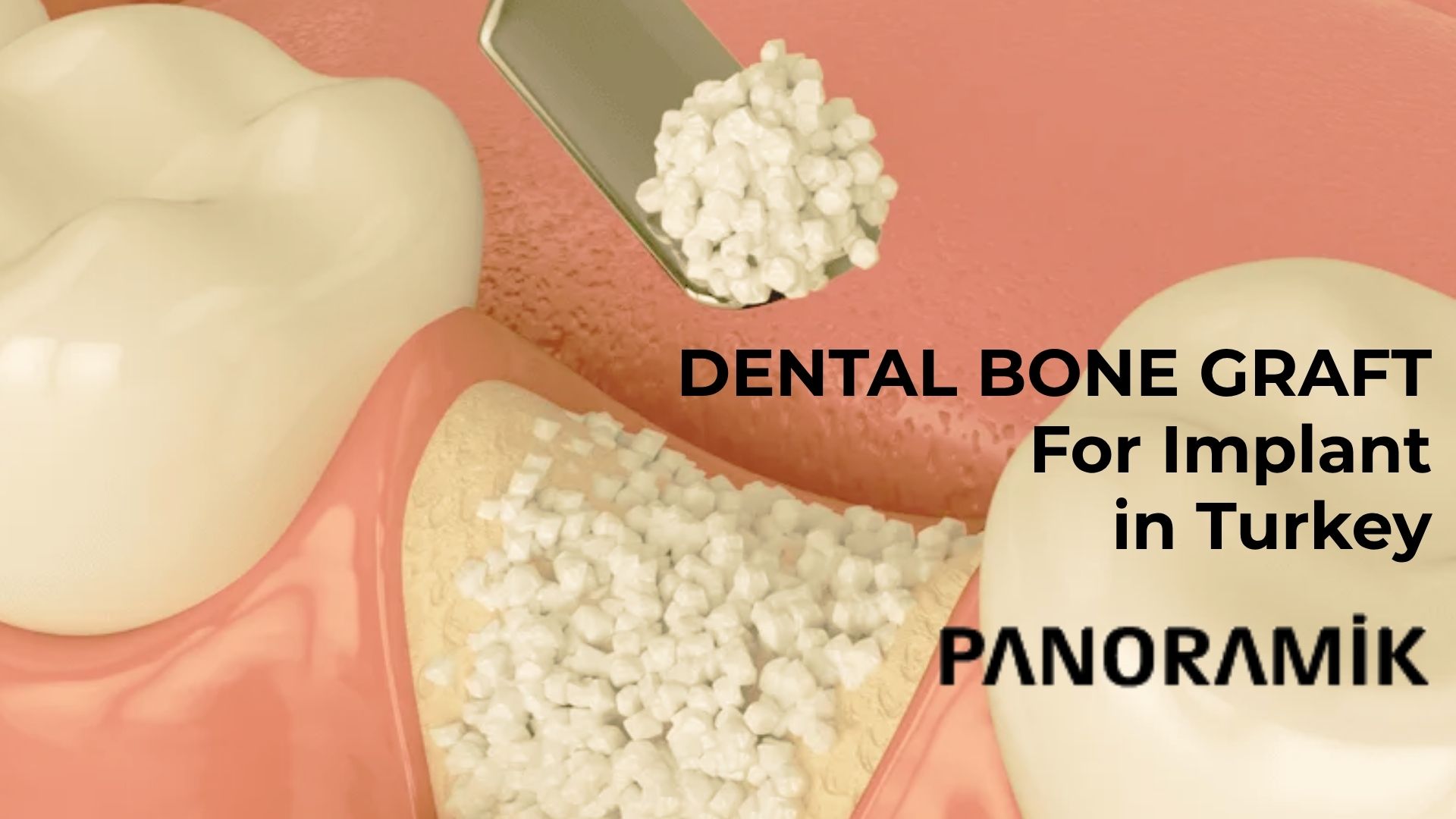 What is seamless-flapless dental implant in Turkey, Antalya?