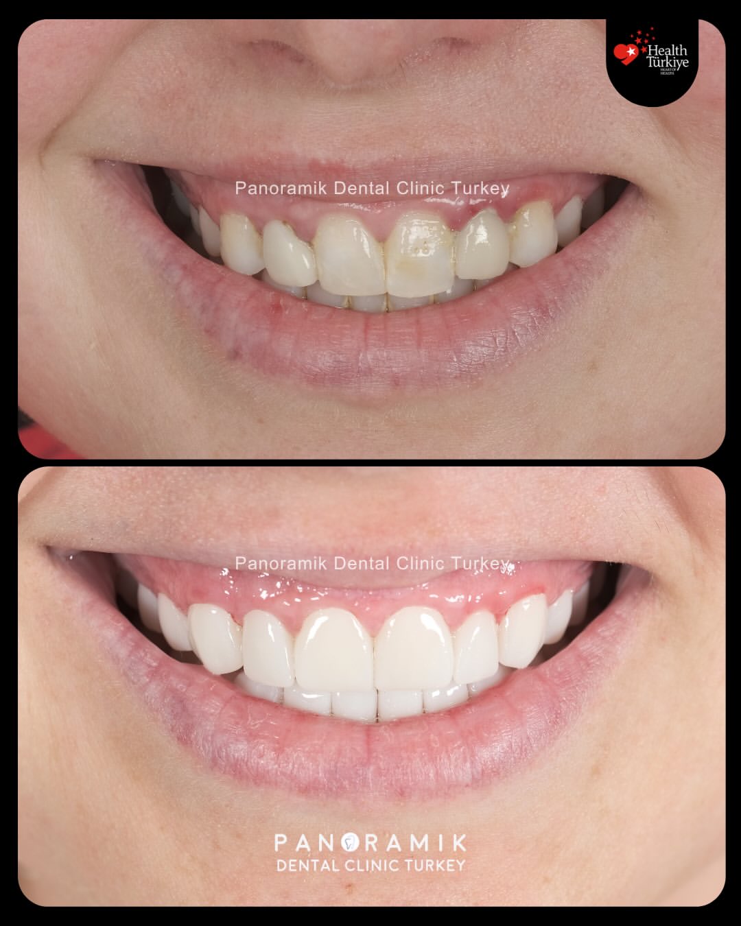 Who is suitable for dental bonding?