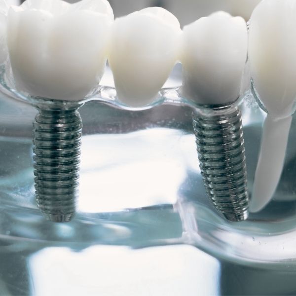 dental-implant-bridge-turkey-antalya