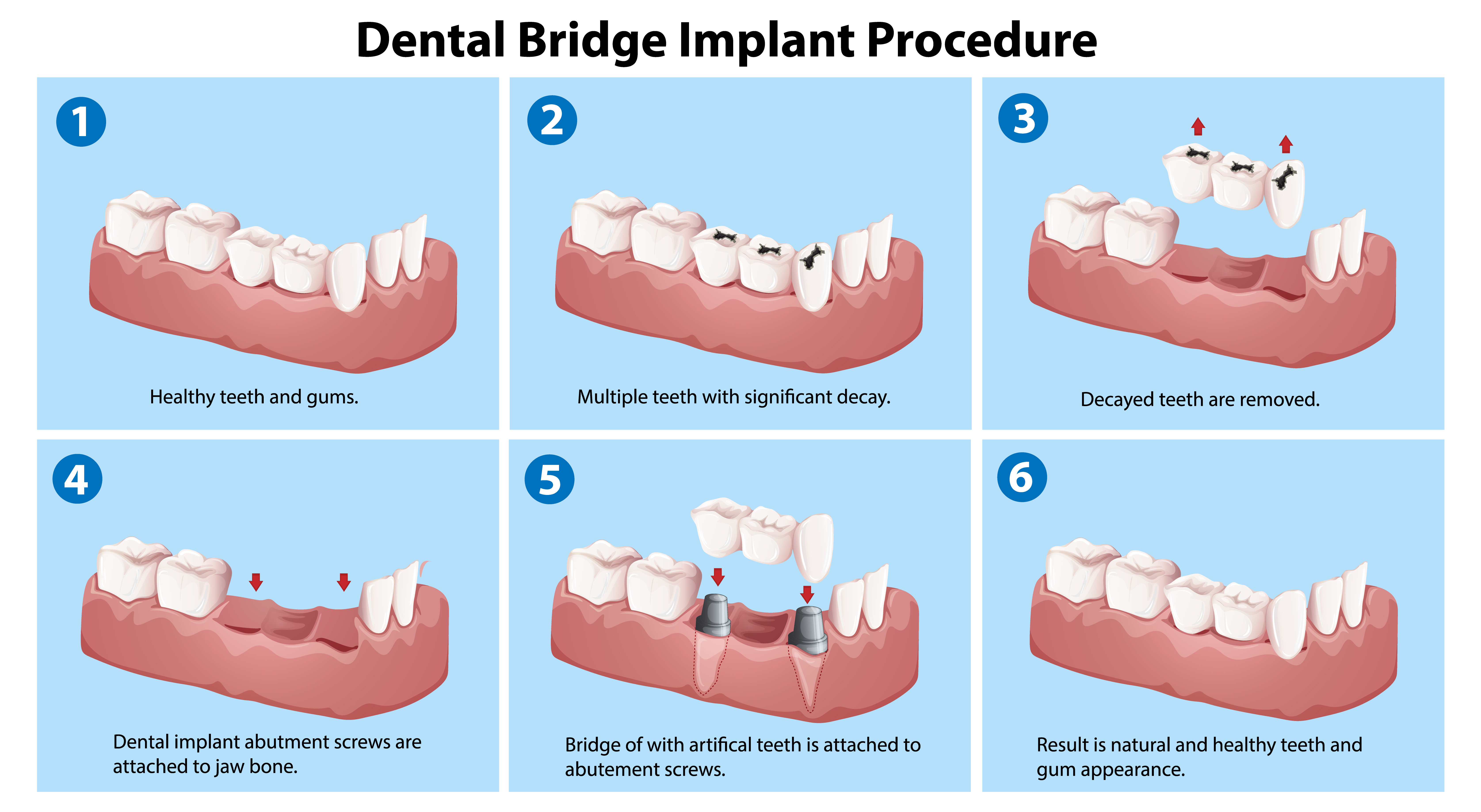 How is dental implant bridge treatment performed? 