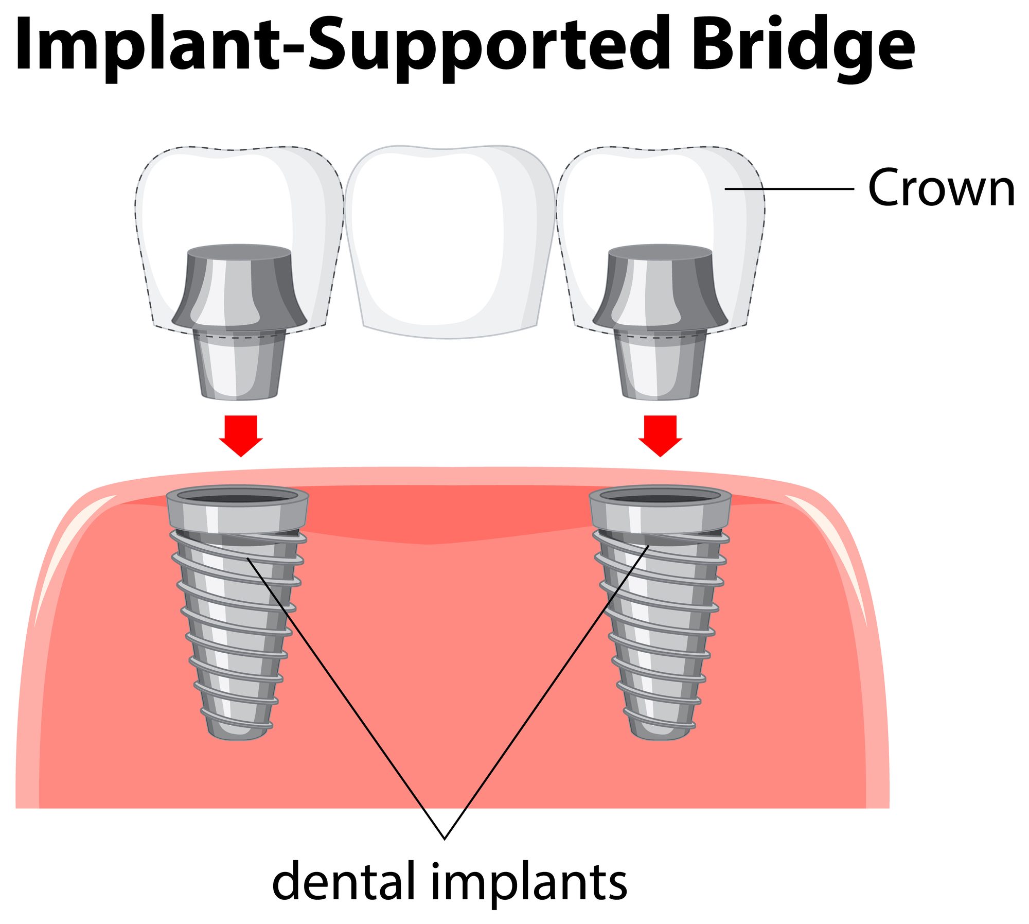 Implant-supported bridge diagram: crowns attached to dental implants