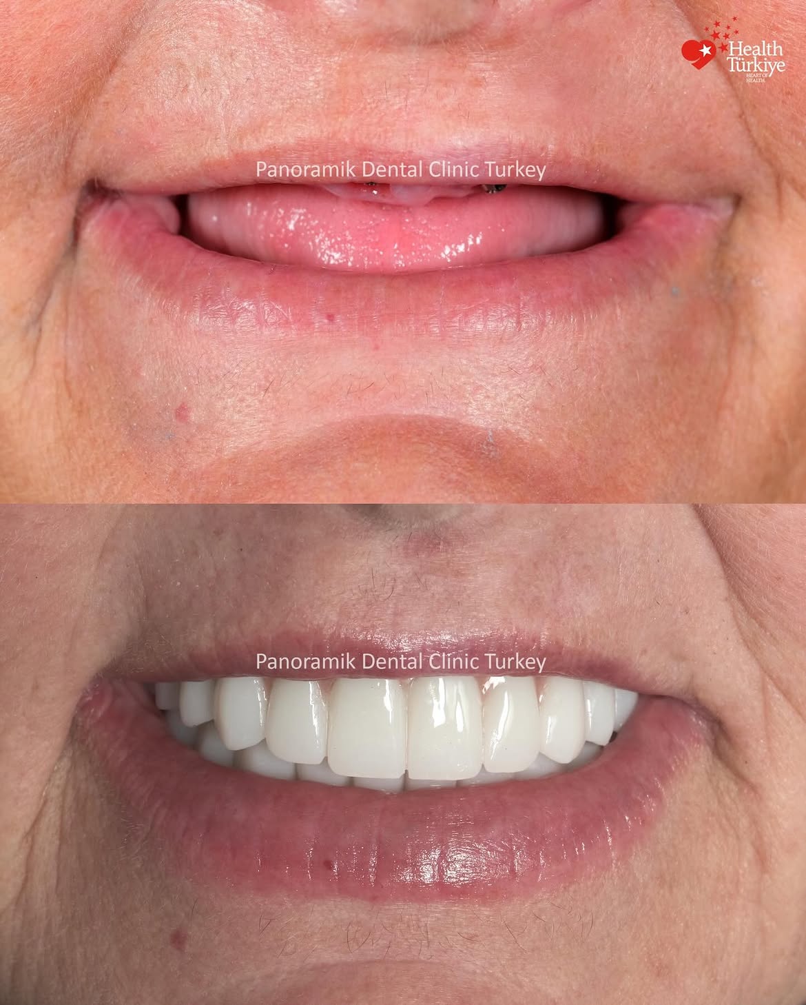 Dental implants before and after in Antalya, Turkey - case 11