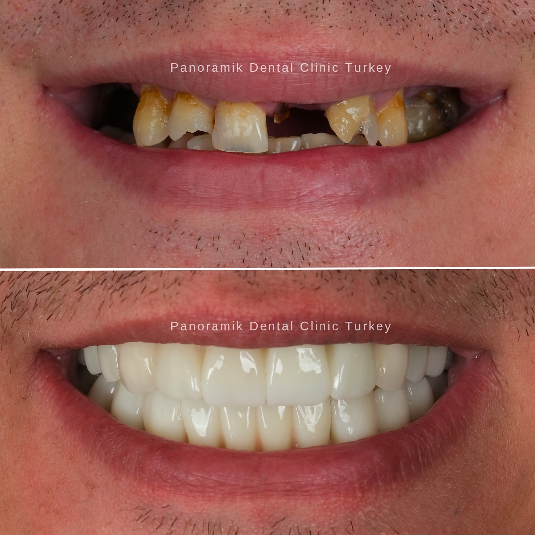 Dental implants before and after in Antalya, Turkey - case 14