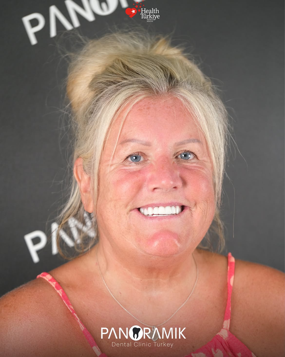 Dental implants before and after in Antalya, Turkey - case 4