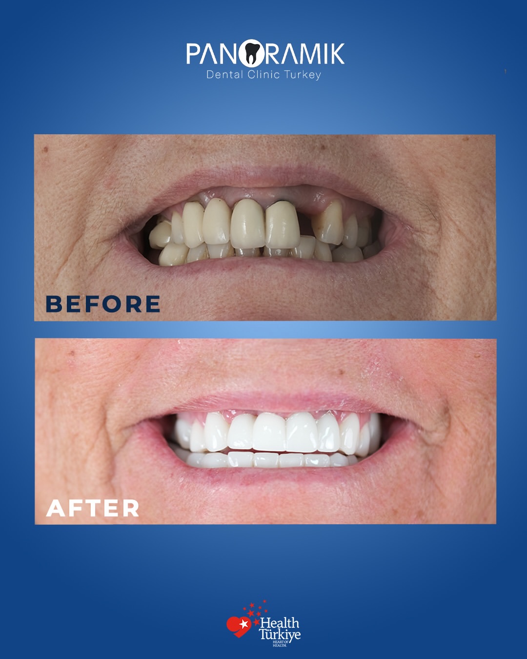 Dental implants before and after in Antalya, Turkey - case 6