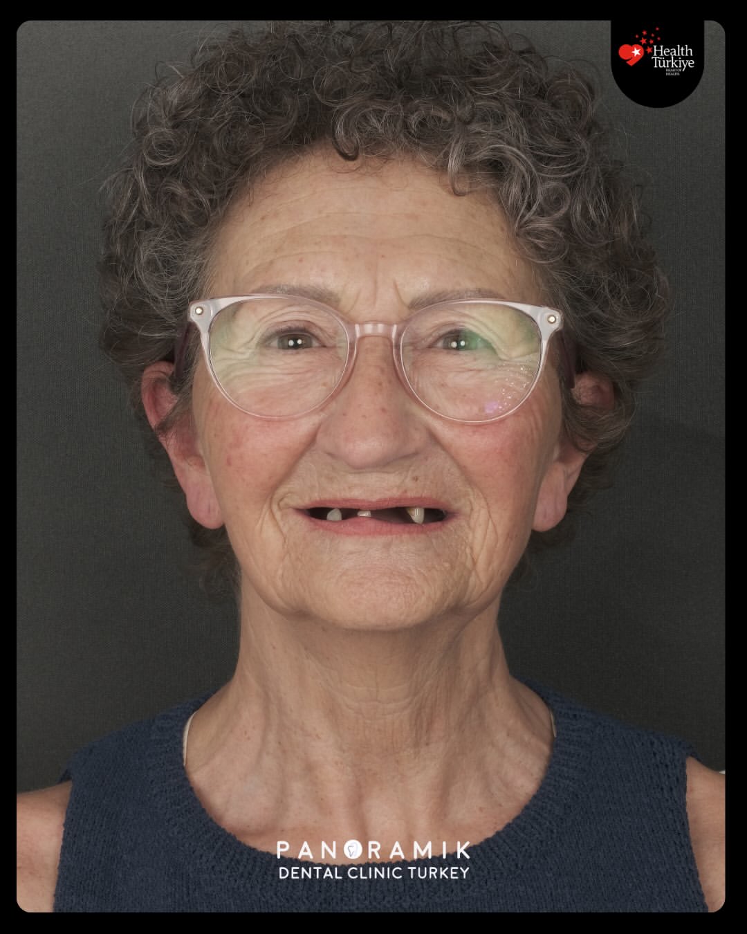 Dental implants before and after in Antalya, Turkey - case 7