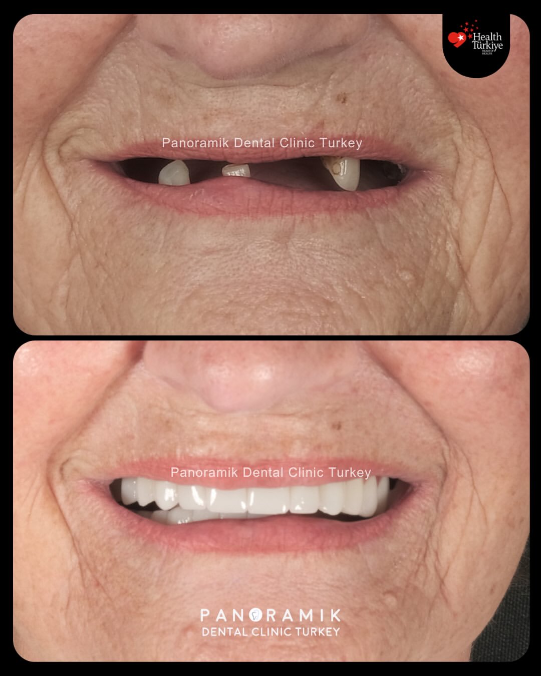 Dental implants before and after in Antalya, Turkey - case 8