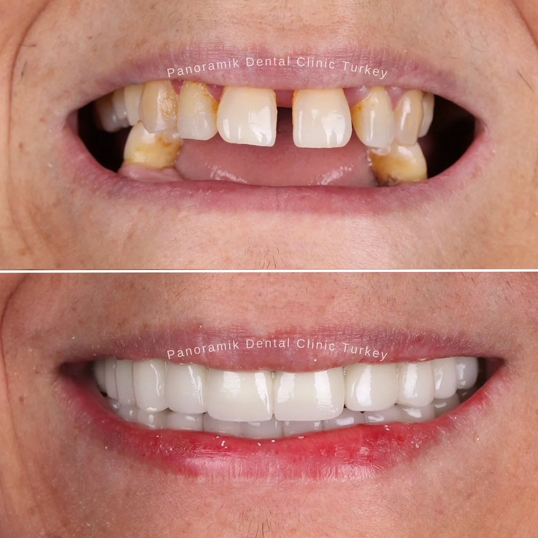 Missing and worn teeth replaced with fixed implant-supported teeth: before and after at Panoramik Dental Clinic Antalya