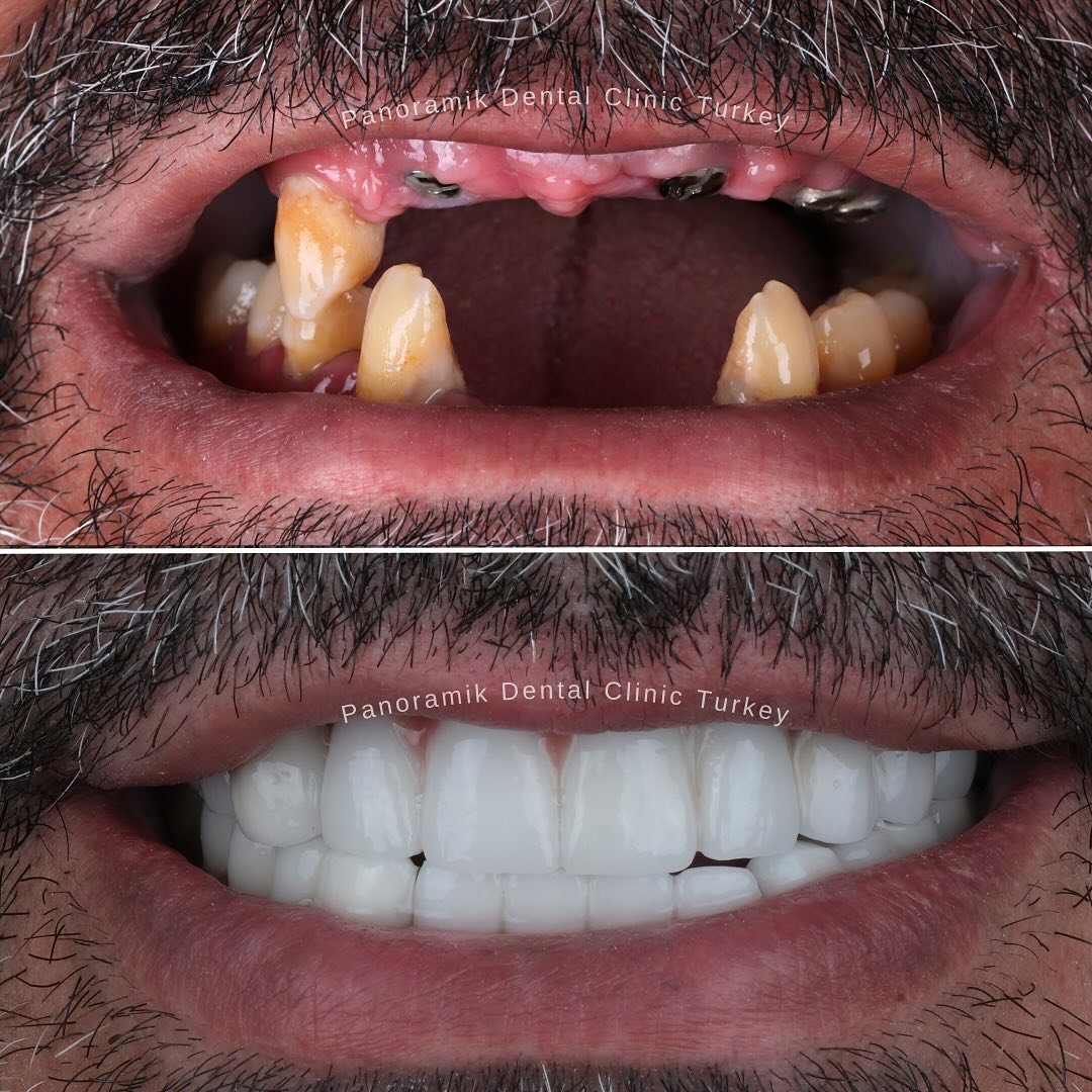 Implants placed in the upper jaw, then fitted with fixed full-arch teeth: before and after at Panoramik Dental Clinic Antalya