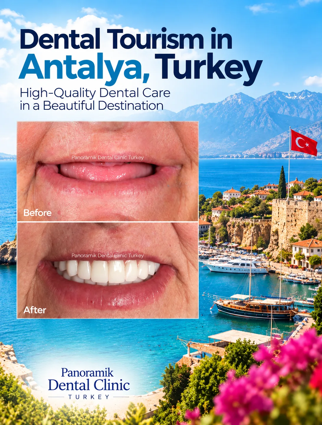 Dental tourism in Antalya, Turkey: before and after smile at Panoramik Dental Clinic