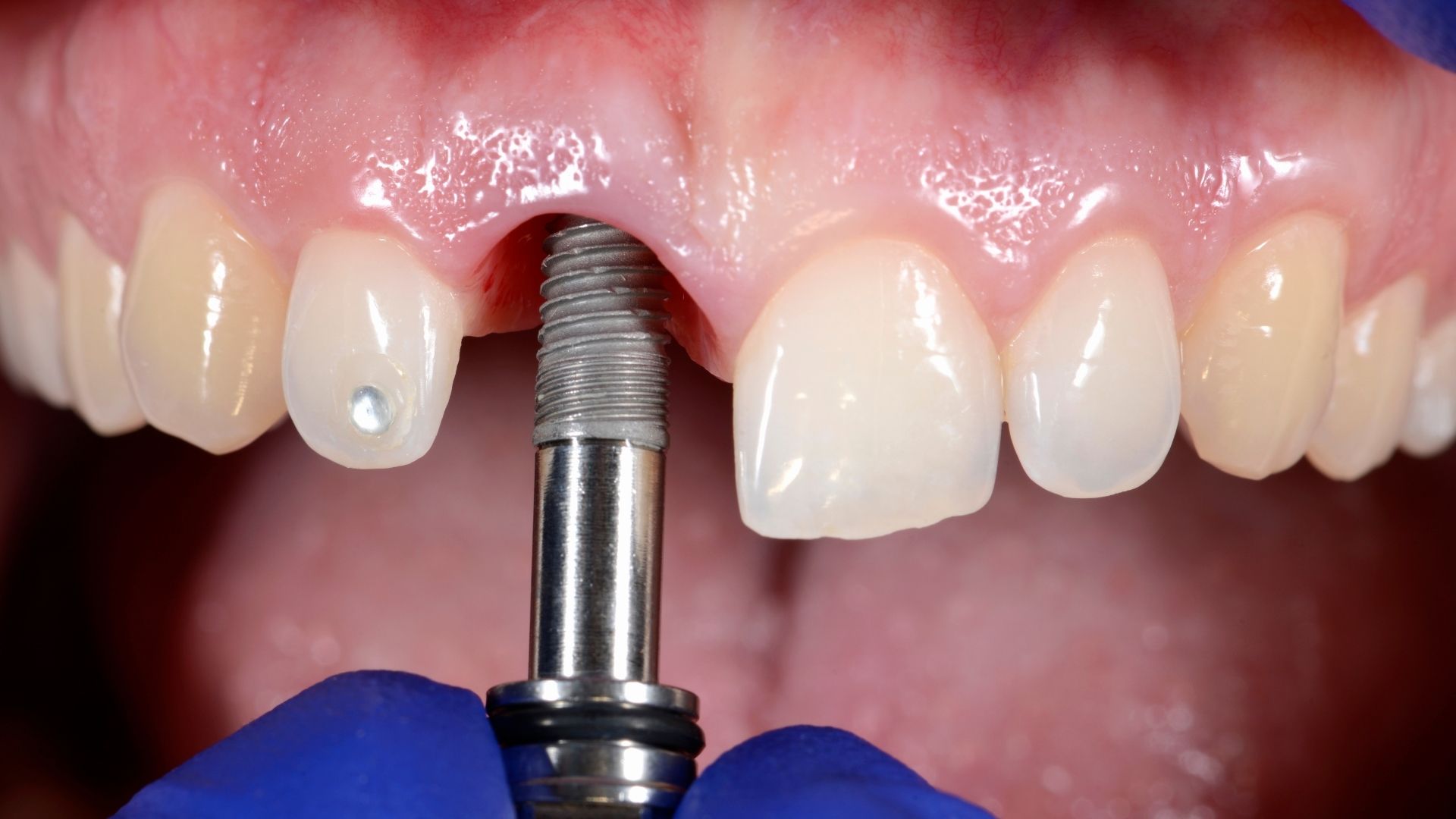 How is a flapless implant performed?