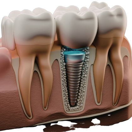 seamless-flapless-implant-turkey-antalya