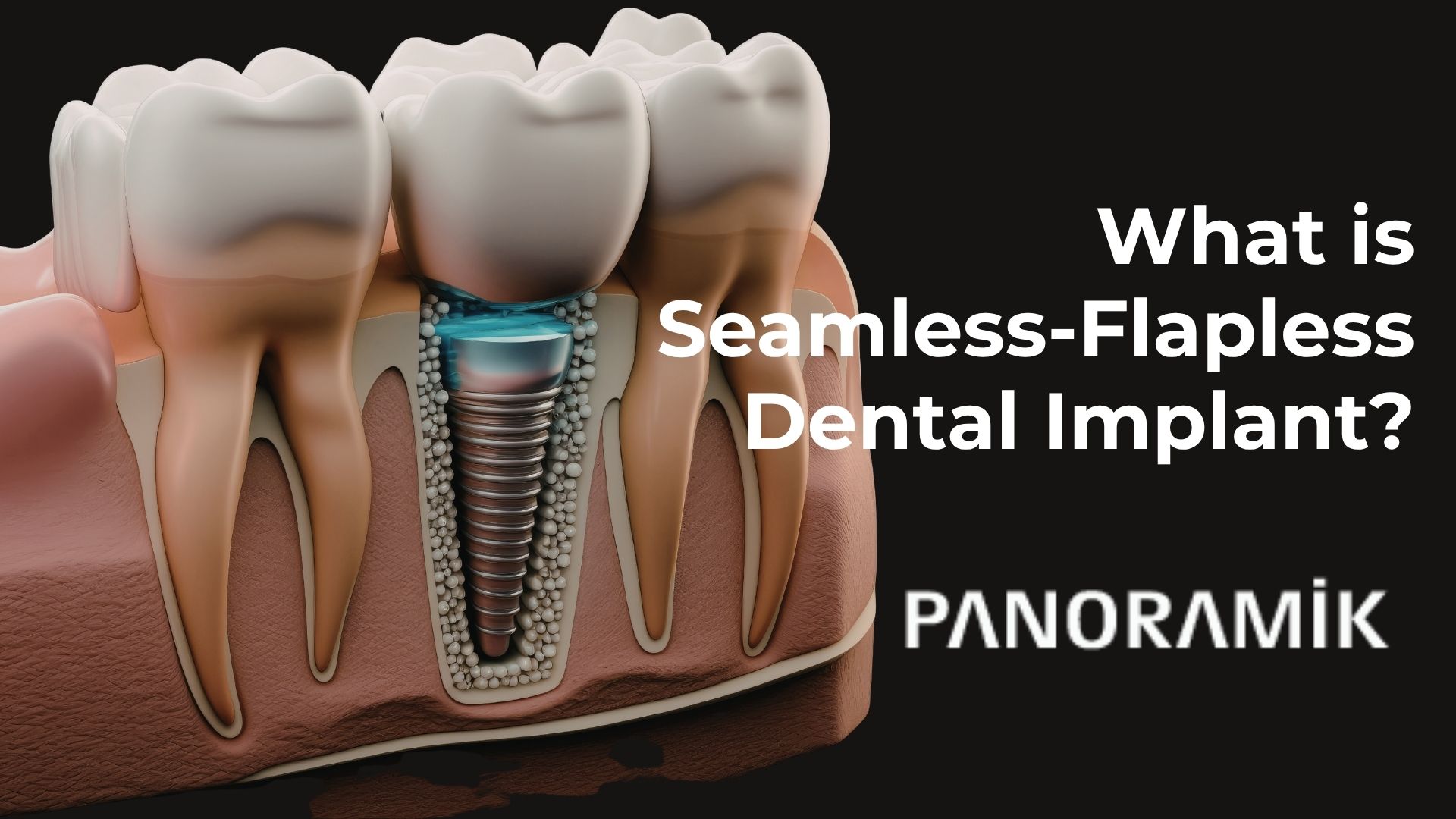 seamless-flapless-implant-turkey-antalya
