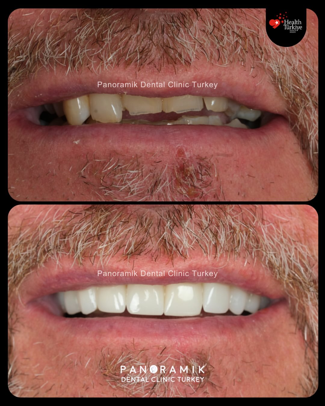 Planned smile makeover before and after at Panoramik Dental Clinic Antalya, Turkey