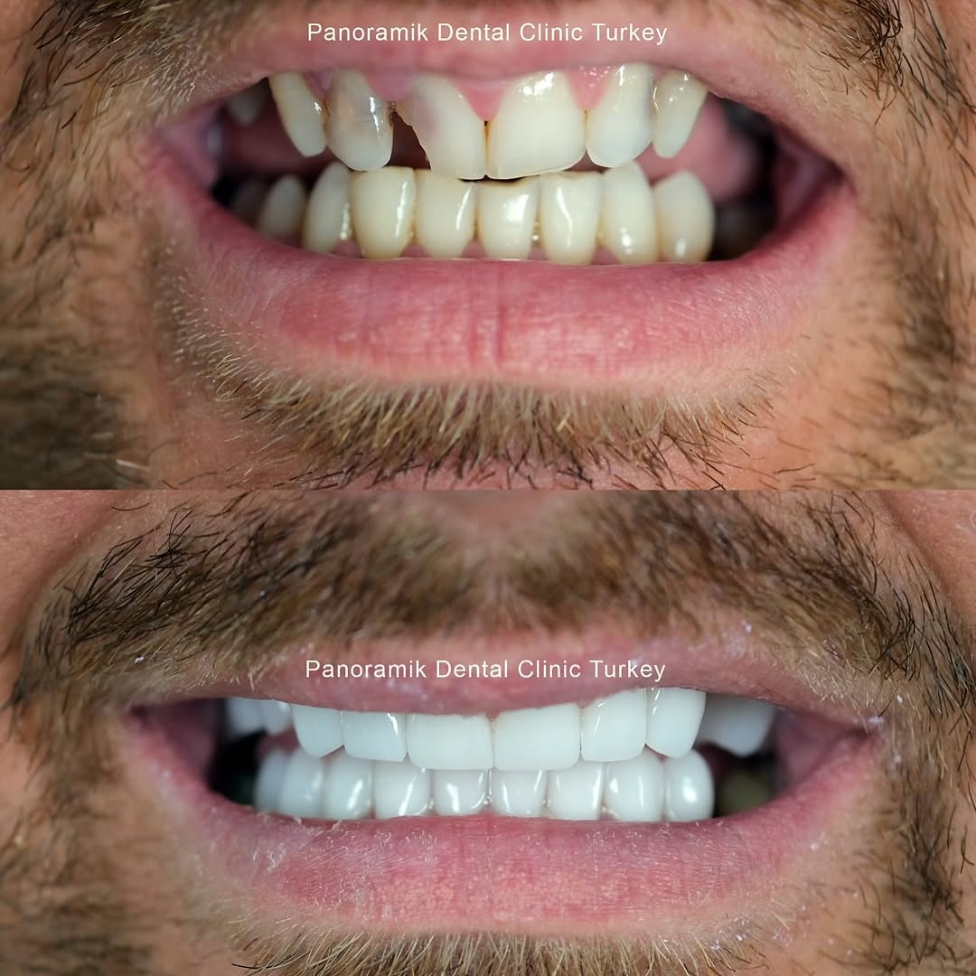 Turkey teeth in Antalya before and after at Panoramik Dental Clinic