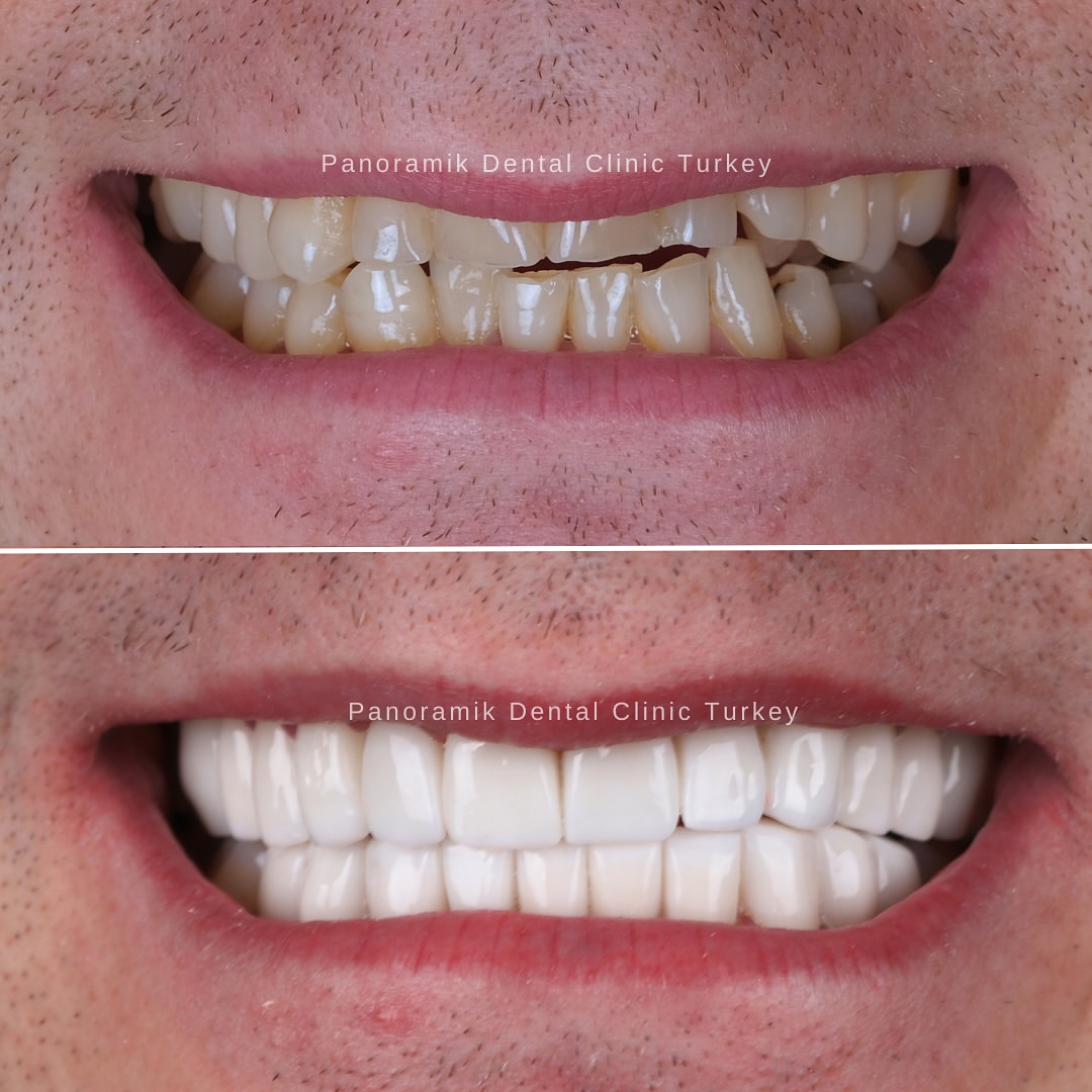 Chipped and worn teeth restored: before and after at Panoramik Dental Clinic Antalya