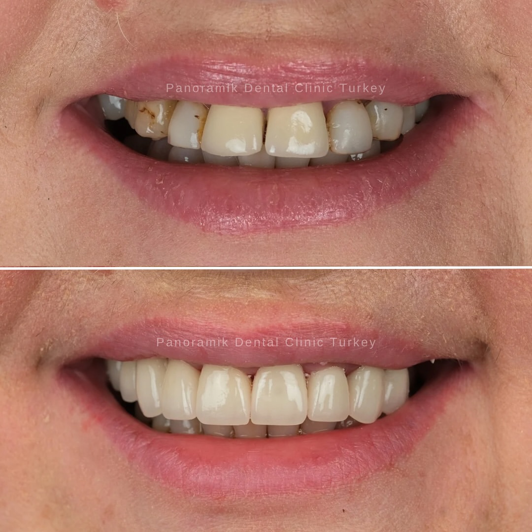 Turkey teeth before and after: smile makeover at Panoramik Dental Clinic Antalya