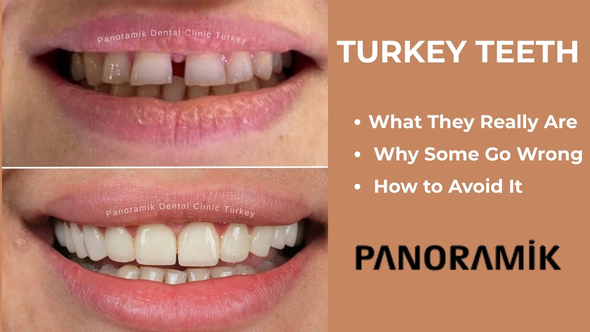 Turkey teeth in Antalya: before and after smile at Panoramik Dental Clinic