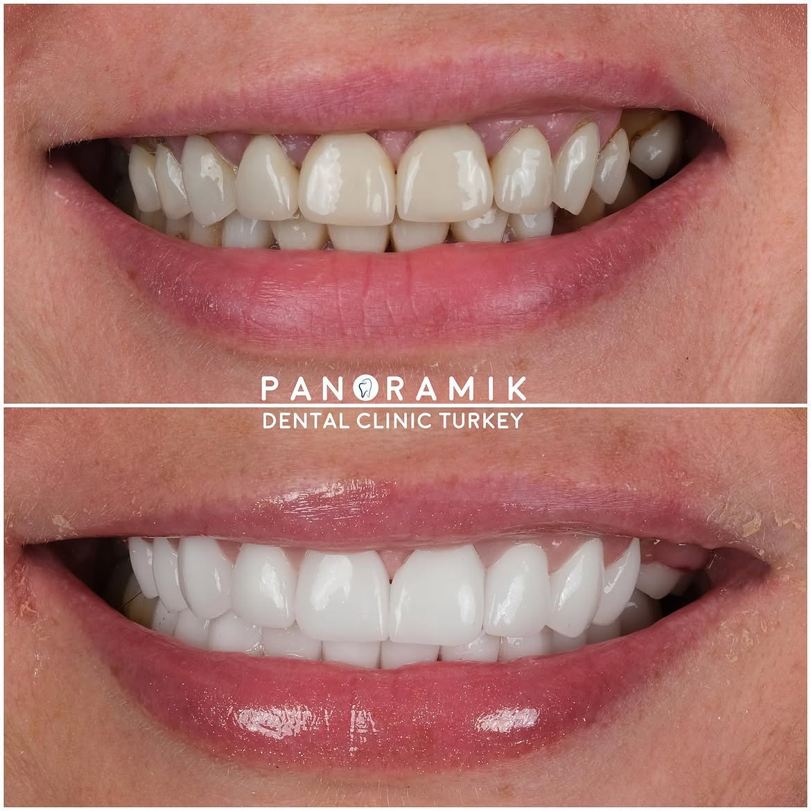 Dental crowns in Antalya Turkey 1