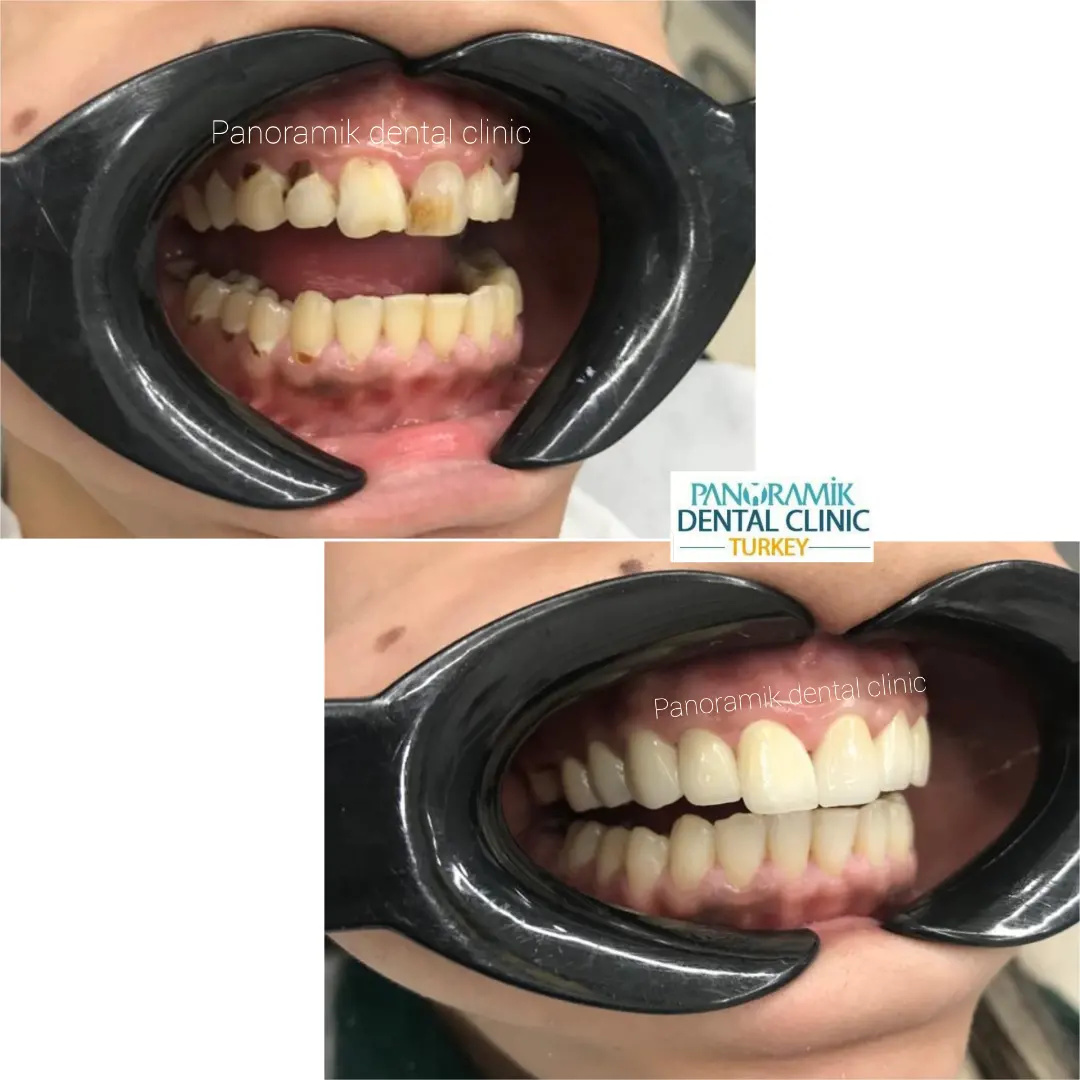 Dental crowns in Antalya Turkey 2
