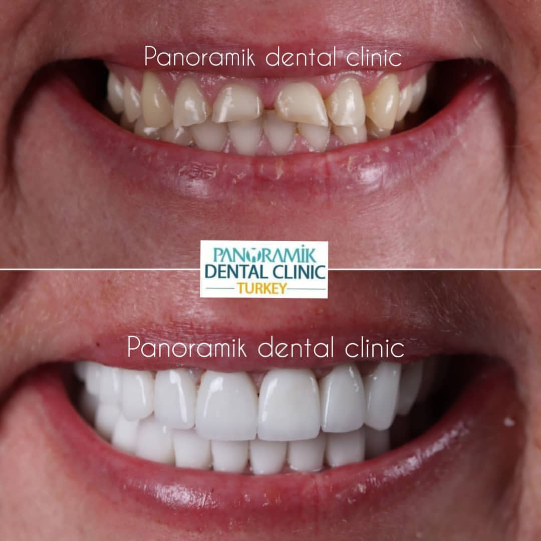Dental crowns in Antalya Turkey 3