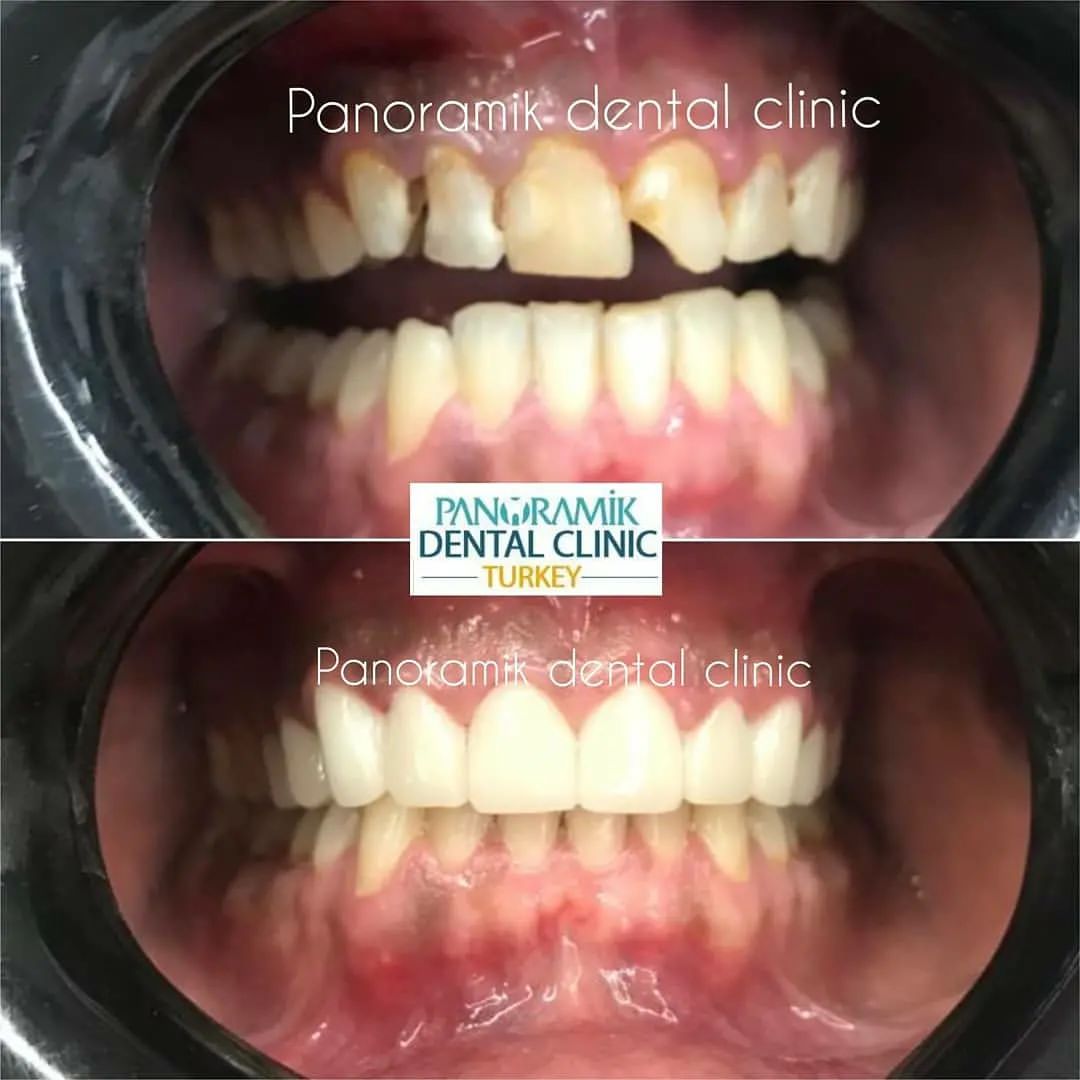 Dental crowns in Antalya Turkey 4