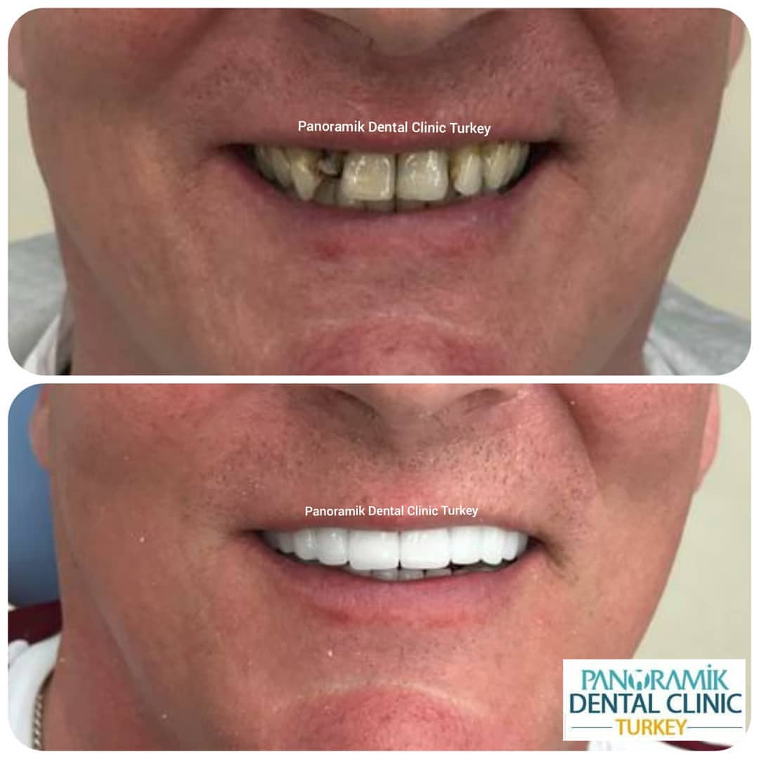 Dental crowns in Antalya Turkey 5