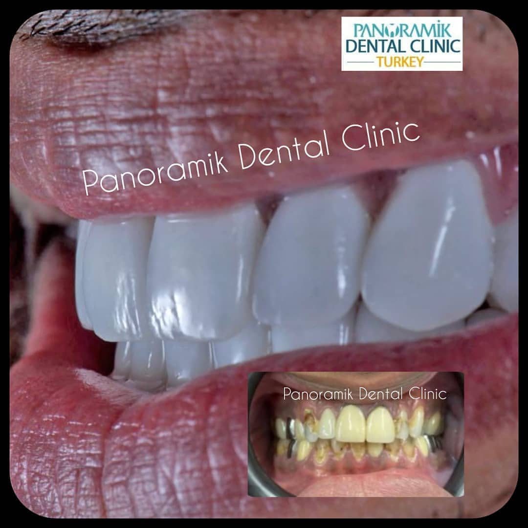 Dental crowns in Antalya Turkey 1