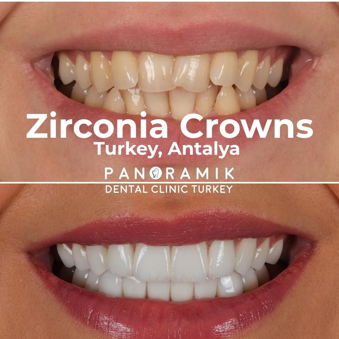 Zirconia dental crown treatment in Antalya, Turkey